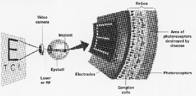 fig5-23TN.gif Concept for artificial retina inserted as part of retina 400x197