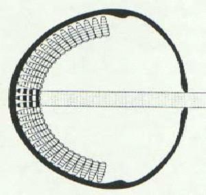 fig6-2TN.jpg Pinhole Eye Diagram 228x200